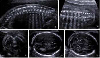 snímek z dvojrozměrného ultrazvukového vyšetření