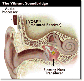 ilustrační obrázek - kochleární implantát vopr ilustrační obrázek - kochleární implantát vopr