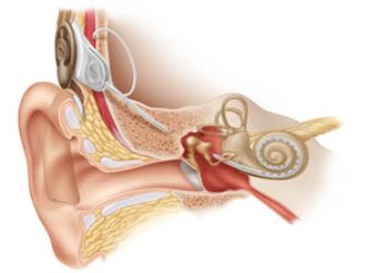 ilustrační obrázek - kochleární implantát ilustrační obrázek - kochleární implantát