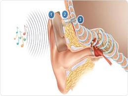 ilustrační obrázek - kochleární implantát baha ilustrační obrázek - kochleární implantát baha
