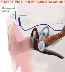 ilustrační obrázek - kochleární implantát abi ilustrační obrázek - kochleární implantát abi
