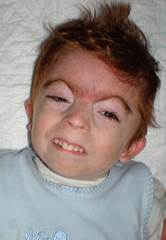 dítě s postižením ilustrační foto