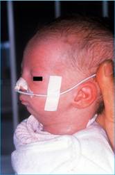 miminko s postižením ilustrační foto