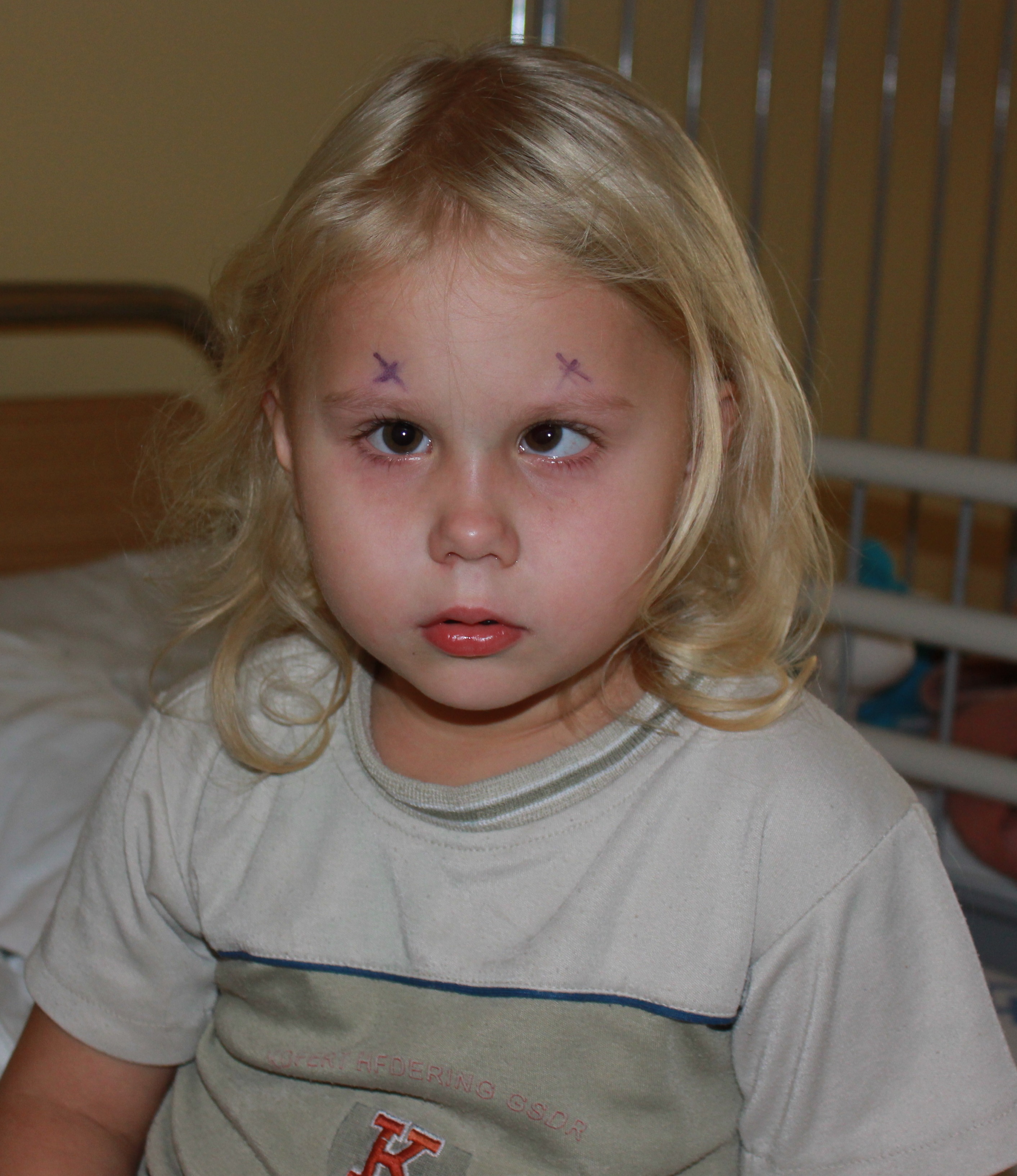 ilustrační foto: jednostranné šilhání u holčičky ilustrační foto: jednostranné šilhání u holčičky