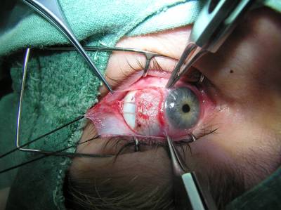 ilustrační foto: operace šilhání ilustrační foto: operace šilhání