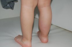 nádor na lýtku u batolete nádor na lýtku u batolete