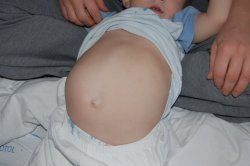 nádor bříška u kojence nádor bříška u kojence