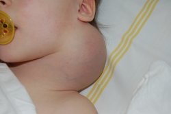 nádor na krku u kojence nádor na krku u kojence