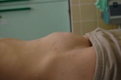 nádor v malé pánvi u školáka nádor v malé pánvi u školáka