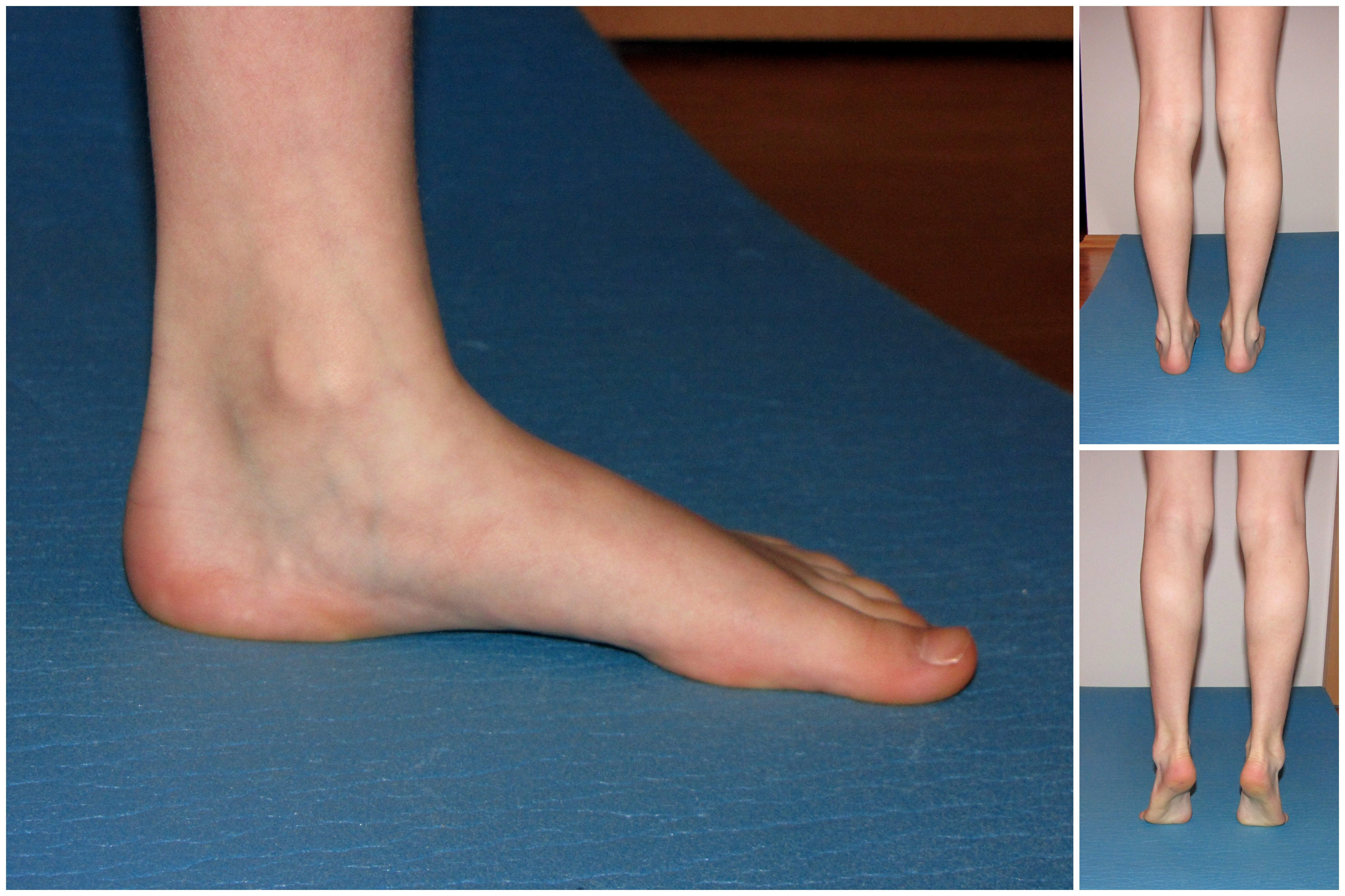 ilustrační foto: přiměřená klenba nožní ilustrační foto: přiměřená klenba nožní