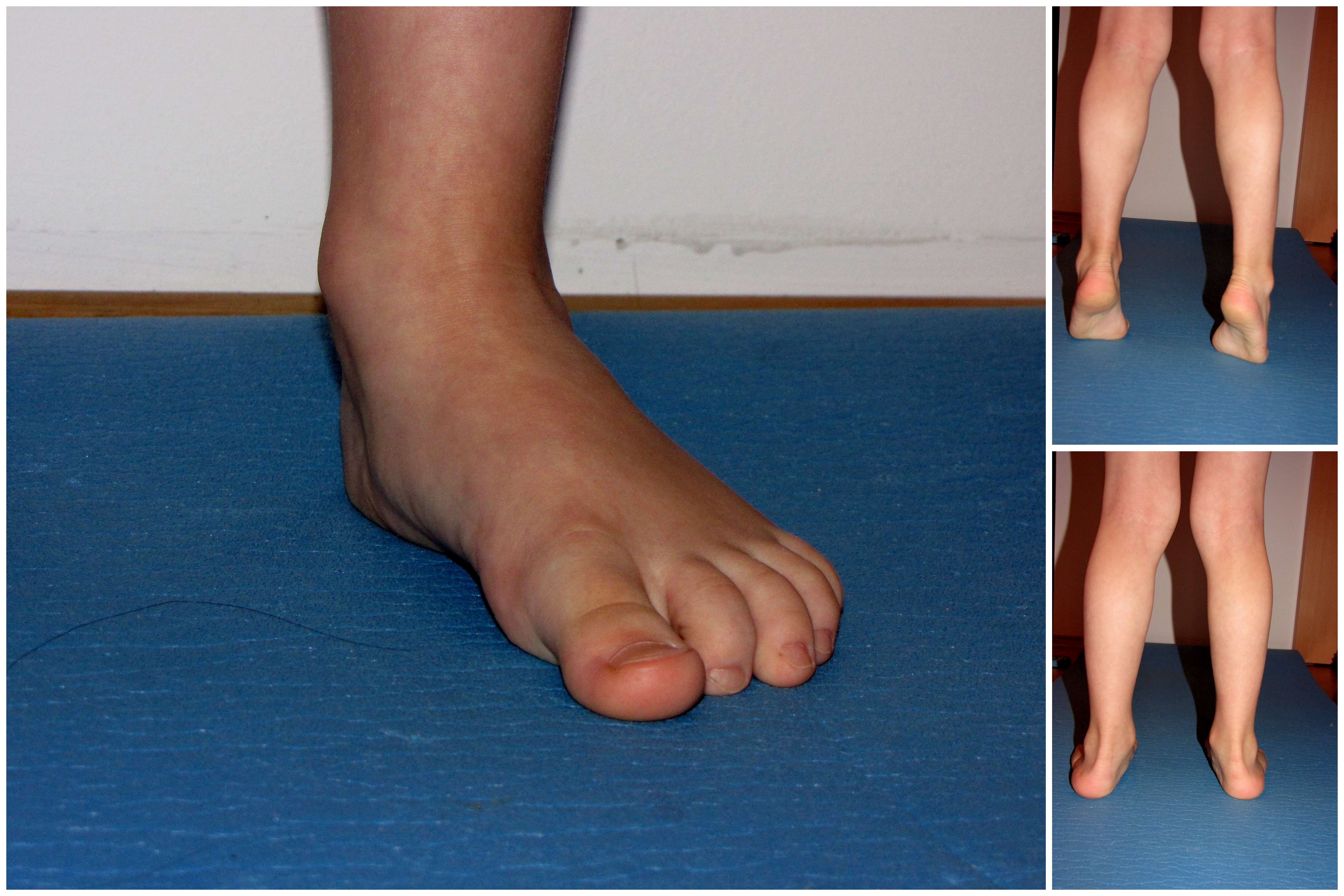 ilustrační foto: nedostatečná klenba nožní ilustrační foto: nedostatečná klenba nožní