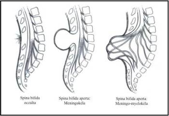 hlavní typy rozštěpových vad páteře