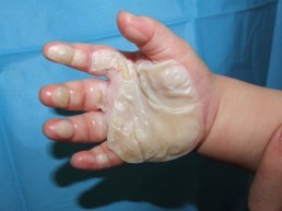 Popálená ruka Popálená ruka