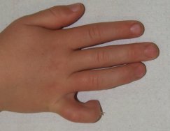 flekční kontraktura flekční kontraktura