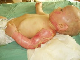 popálené dítě popálené dítě