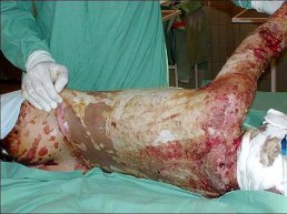 popálení plamenem popálení plamenem