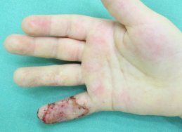 přihojený transplantát přihojený transplantát