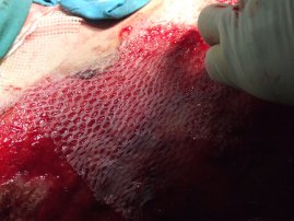 transplantace kůže transplantace kůže