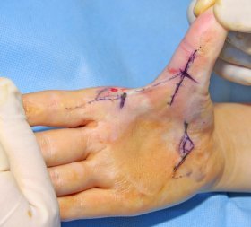 vyznačení jizevnatých pruhů vyznačení jizevnatých pruhů