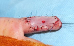 všití transplantátu všití transplantátu