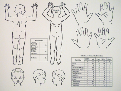 rozsah popálenin rozsah popálenin