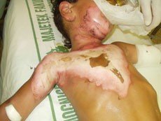 popálené dítě popálené dítě