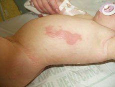 batole s opařením batole s opařením