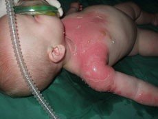 batole opařené kávou batole opařené kávou