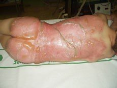 rozsáhlé opaření rozsáhlé opaření