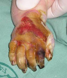 popálení třetího stupně popálení třetího stupně