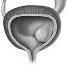 obrázek – ureterokéla