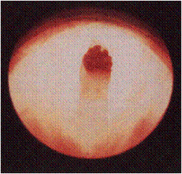 chlopeň zadní močové trubice