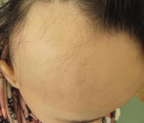 Rozsáhlá alopecia areata